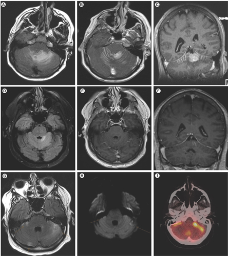 Figure 2. Pretreatment, post-treatment, and recurrence images for case 2. Pretreatment FLAIR image showing edema in the superior cerebellar vermis (A). Pretreatment axial (B) and coronal (C) post-gadolinium images showing mass-like enhancement in the superior cerebellum and leptomeningeal enhancement along the folia. Post-treatment FLAIR image showing significantly improved edema (D). Post-treatment axial (E) and coronal (F) post-gadolinium images showing near-complete resolution of cerebellar enhancement. Subsequent MRI 2 months later showing recurrent abnormal cerebellar FLAIR signal abnormality (G) with corresponding restricted diffusion (H) and abnormal hypermetabolism (I).