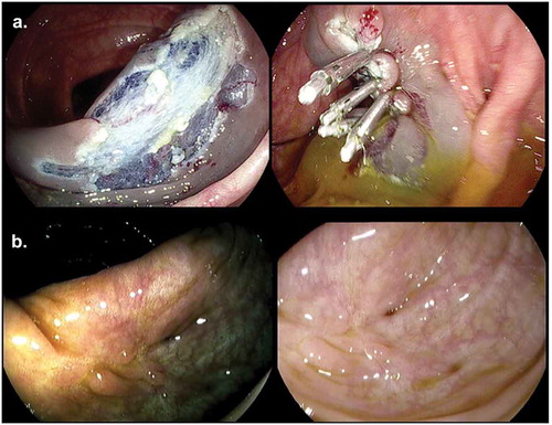 Figure 4. (a). Prophylactic clip closure of resection field after piecemeal EMR. (b). Clip artifact in scar after EMR with HDWLE and Iscan.