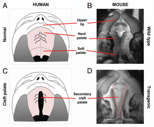Figure 2 Correlation between human and mouse palates. (A) Normal human upper lip, hard palate and soft palate. (B) Normal mouse upper lip, hard palate and soft palate. (C) Cleft of the secondary palate in human patient. (D) Clefting of secondary palate in transgenic mouse.