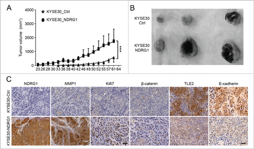 Figure 5. Ectopic overexpression of NDRG1 promotes tumor growth in vivo. (A) Tumor volume was measured every 2 to 3 d after subcutaneous inoculation with 5×106 cells/animal. KYSE 30 cells overexpressing NDRG1 (KYSE 30-NDRG1) enhanced the growth of the xenograft tumors compared with that of inoculations using parent cells (P < 0.001). (B) Photographs of the dissected xenografts using the same magnification scale. (C) Xenograft tissue was subjected to immunohistochemical analysis for NDRG1, MMP1, Ki67, β-catenin, TLE2 and E-cadherin, Scale bar, 100 μm.