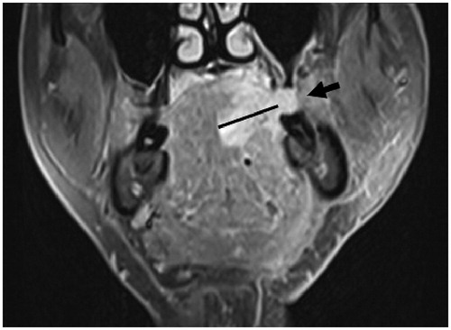 Figure 2. Coronal T1-weighted fat-suppressed contrast-enhanced MR image shows exophytic tumor growth (arrow). The exophytic part of the tumor was excluded when measuring the invasion depth. MR: magnetic resonance.