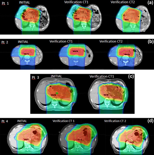 Figure 3. Target coverage evaluation between initial CT scan and verification scans for the four patients (a,b,c,d) actually treated with PT.