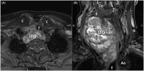Figure 4. A 73-year-old female had right grade 2 and type C ITG (A) Axial T1 enhanced MRI shows the posterior extension of ITG to retrotracheal region with left deviation and compression of the trachea. (B) Coronal T1 enhanced MRI shows the inferior margin of ITG below the aortic arch convexity. (ITG: intrathoracic goiter; Ao: aorta; T: trachea; C: clavicle).