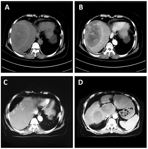 Figure 1. CT scan of the liver in Case #1. A huge 11.1 × 7.5 × 9.0 cm mass was identified in segment VIII. It showed a rich blood supply within the tumour (A and B, plain scan and arterial phase, respectively). Enhanced CT scan was performed at 3 months after surgery. Post-operative image of the liver after partial resection (C). Multiple metastases were identified in the liver (D).