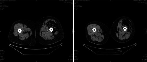 Figure 1 Diffuse emphysematous phlegmon of both thighs, mostly on the left.