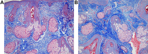 Figure 8 (A and B) Trichrome stain in subject using bland moisturizer shows thin collagen bundles in the papillary and mid reticular dermis pre-treatment (A), while day 90 shows markedly increased thickness of collagen bundles (B).
