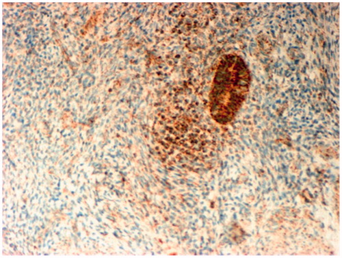 Figure 5. Immunohistochemistry analysis expression of VEGF in ectopic endometrium and surrounding myometrium stroma with signs of infiltration. IHC MAT to VEGF, original magnification 160×.