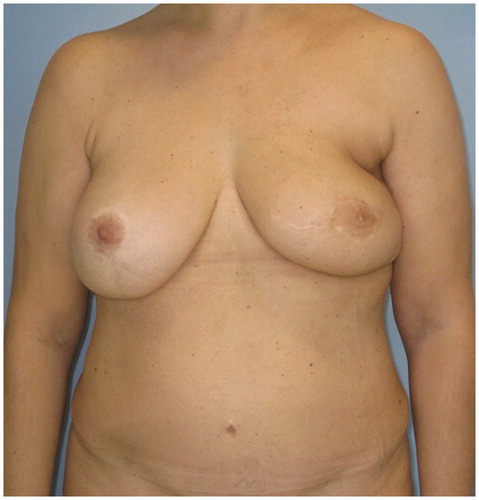 Figure 3. Frontal view 5 months after surgery. After 5 days, the flap slowly regained its normal aspect and follow up showed no liponecrosis.