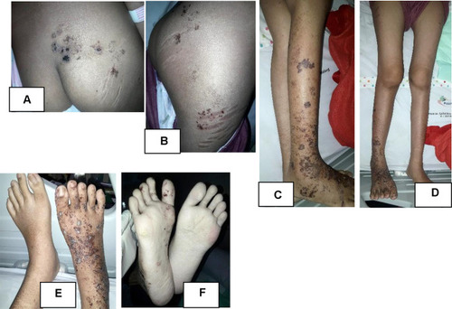 Figure 5 Follow up at 10th day. Showed hyperpigmented patches and and several sagging bullae, some burst into erosion covered by brownish crust at gluteus (A), lateral side of femur dextra (B), cruris dextra (C), and dorsum and plantar pedis region (D–F).