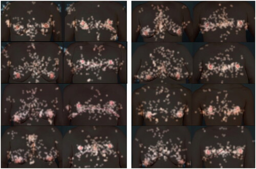 Figure 8. Corresponding pre- and post-op photos of the eight patients with an overlay of the eye tracking technology demonstrating where the observers fixated their gaze.