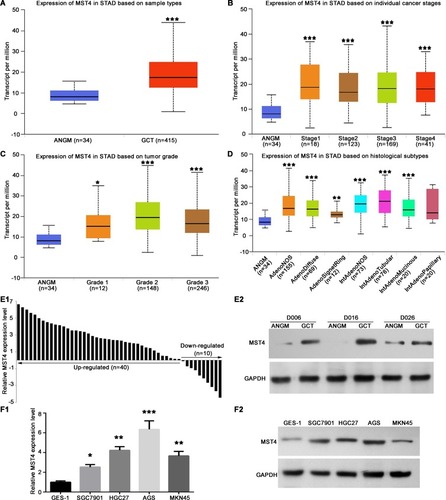 Figure 1 MST4 expression was significantly upregulated in gastric cancer (GC). (A) The mRNA expression profile of MST4 in GCTs and ANGMs was analyzed by UALCAN program using TCGA data. GCT, GC tissue; ANGM, adjacent noncancerous gastric mucosa. (B) Expression of MST4 in TCGA database based on tumor stages. (C) Expression of MST4 in TCGA database based on tumor grade. (D) Expression of MST4 in TCGA database based on histological subtypes. (E) MST4 expression was significantly up-regulated in GCT. (E1) qRT-PCR was used to analyze MST4 mRNA expression in GCTs (n=50) and ANGMs (n=50). (E2) Western blot results showed that MST4 protein expression was higher in GCTs than in ANGMs. (F1 and F2) MST4 expression was significantly up-regulated in GC cell lines. (F1) Quantitative real-time PCR (qRT-PCR) analysis of MST4 mRNA showed, compared with normal gastric epithelial cell line GES-1, MST4 mRNA expression elevated in GC cell lines including AGS, SGC-7901, HGC27 and MKN45 cell line. (F2) Western blot results showed MST4 protein was overexpressed in AGS, SGC-7901, HGC27 and MKN45 cell line relative to GES-1 cell line. *P < 0.05; **P < 0.01; ***P < 0.001.