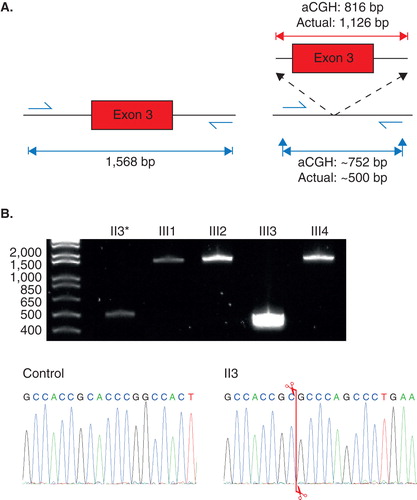 Figure 4. PCR amplification of the region encompassing exon 3 of the RYR2 gene. A: Amplicon sizes of the expected PCR products using DNA from an unaffected individual carrying no deletion of exon 3 of the RYR2 gene (left), and for DNA with the exon 3 deletion (right). The deletion size according to aCGH and the actual deletion size confirmed by Sanger-based sequencing are shown (above red lines). The expected PCR amplicon size of the deletion mutant according to the aCGH data and the actual product size are both shown. B: 2% agarose gel showing the results of PCR amplification of the genomic region encompassing exon 3 of the RYR2 gene for the proband (II-3) and her four children (III-1 to III-4). Chromatogram of the control and the proband showing where the breakpoint is (indicated by the red line).