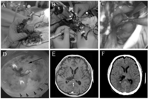 Figure 1. (A), Photograph showing the procedures for inserting the clear plastic sheath (ViewSite) into the brain using a navigation system (BrainLab). (B) The bimanual (bipolar forceps and suction) technique as visualized through the endoscope into the sheath. (C) Intraoperative photographs showing the procedures for dissecting the tumor from the surrounding normal brain tissue using the bimanual technique. These procedures are similar to those used when performing the operation under a microscope. (D) The superficial part of the tumor (arrow) with some surrounding white matter (arrowheads) is visible through the transparent sheath. Preoperative [contrast-enhanced T1-weighted axial, (E)] magnetic resonance (MR) images revealing a right thalamic low-grade glioma prior to endoscopic resection. Subtotal resection was achieved. (F) Postoperative computed tomography axial images obtained in a patient who underwent subtotal endoscopic resection of a thalamic low-grade astrocytoma; the patient was neurologically unchanged after surgery.