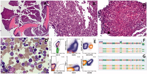 Figure 1. (a) Low power view showing hypercellular marrow. (b) High power view showing “blastoid” morphology in high grade B-cell lymphoma (HGBCL). (c) High power view showing CLL/SLL. (d) Aspirate smear showing dimorphic population of small lymphocytes with mature chromatin and large lymphoid cells with dispersed chromatin and prominent nucleoli. (e) Flow cytometric plots showing immunophenotype of HGBCL (orange) and CLL/SLL (blue). (f) SNP array findings in HGBCL showing homozygous deletion at 13q14.2 (including RB1 and SETDB2) and CN-LOH of 17p terminal to 17p11.2 (including TP53). (g) SNP array findings in CLL/SLL showing a 13q14.2 hemizygous deletion for RB1 and homozygous deletion for SETDB2 and loss of 17p13.1 to 17p12 (including TP53).