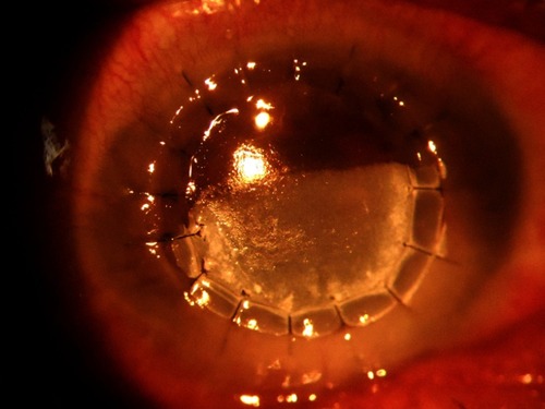 Figure 1 White granular deposits in the inferior cornea in the area of the epithelial defect at day 7 after corneal transplant.