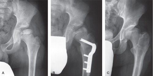 Figure 3. A boy (9.5 years of age at diagnosis) with unilateral Perthes’ disease on the left side. The radiographs were taken at onset (A), at 1-year follow-up (B), and at 5-year follow-up (C). Measurements for the affected hip are given below.