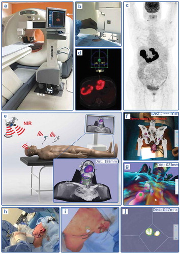 Figure 3. 3D nuclear detection modalities for radioguided interventions. (a–b) Setup for navigated 18F-FDG PET-biopsy using a registered robotic biopsy arm (from [Citation257]). (c–d) Example of trajectory planning in patient with suspected lymphoma. (e) Setup for SPECT/CT-based surgical navigation in head and neck cancer SN procedure, showing near-infrared (NIR) tracking of patient and instrument positions for registration with the patient scans. (f) Augmented reality overlay of SPECT/CT scan in the operating room for a penile cancer SN procedure (from [Citation180]). (g) Virtual reality navigation towards SN in breast cancer using the SPECT/CT patient data (from [Citation101]). (h) Intraoperative creation of 3D freehand SPECT images using a tracked portable gamma camera, including subsequent augmented reality overlay (i) and virtual reality navigation (j) during a head and neck cancer SN procedure.