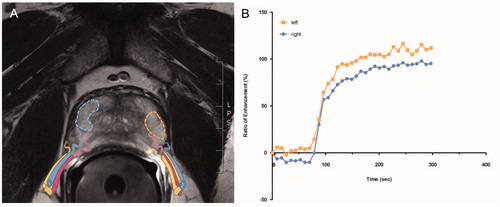 Figure 1. ROI’s placed on the right and left side of the peripheral zone of the prostate in hyperintense areas of axial T2w sequence. The NVB indicates the perfusion coming from posterolateral direction (A). Ratio of enhancement measured over time via signal intensity curves of contrast agent (B).
