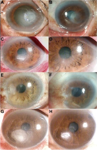 Figure 2 (A) Case 2. At initial examination, a slit-lamp photograph showed a central corneal infiltrate with a large epithelial defect and hypopyon. (B) After 6 months, biomicroscopy showed complete resolution, with a faint scar. (C) Case 3. At initial examination, a slit-lamp photograph showed a central stromal infiltrate with endothelial plaque and hypopyon. (D) After 4 months, biomicroscopy showed complete resolution, with a faint scar. (E) Case 4. At initial examination, a slit-lamp photograph showed mild conjunctival injection and a peripheral corneal infiltrate. (F) After 3 months, biomicroscopy showed complete resolution, with a faint scar and a peripheral conjunctival flap remnant. (G) Case 5. At initial examination, a slit-lamp photograph showed a paracentral stromal infiltrate with an endothelial plaque. (H) After 2 months, biomicroscopy showed resolution of the corneal infiltrate.