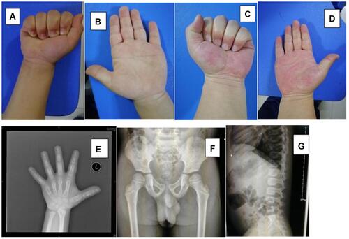 Figure 2 Clinical and radiological features of patient 2 and patient 3: (A–D) The presence of small hands, but without joint contracture; (E–G) The images of the left hand, pelvis and vertebral column of patient 2 revealed shortened tubular bones in the hands and beak-like femoral heads.