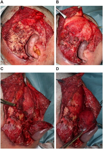 Figure 2. First surgery. (A) Necrosis from the subcutaneous tissues to the temporal fascia. (B) After the necrotic tissue excision, the temporalis muscle is exposed. (C) Creating the temporalis muscle flap. (D) The temporalis muscle flap is covered over the detached auricle.