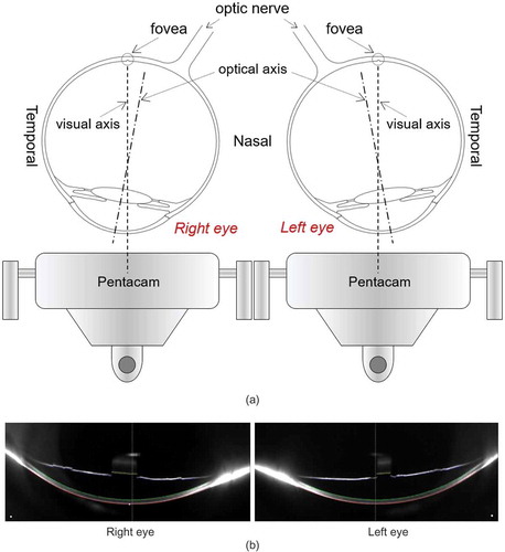 Figure 1. (a) The tilted eye position to allow focused light rays to fall on the fovea during the topography scanning process. (b) Pentacam HR Scheimpflug images for an Italian participant, 75 years old female, showing horizontal cross-sectional views of right and left eyes during the topography scan.