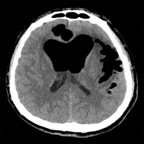 Figure 4 Computed tomography revealing obvious pneumocephalus in the intracranial lobe, with compression of the brain tissue, and marked enlargement of the ventricles and fissures.