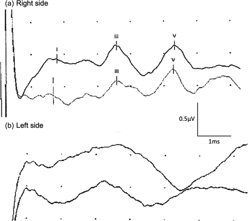 Figure 2. MM’s auditory brainstem responses (ABR) performed in June 2023. The ABR in the right ear (panel a) shows normal responses and the latencies for wave I, wave III and wave V are 1.7 ms, 3.6 ms, and 5.3 ms whereas for the ABR in the left ear (panel b), no discernible waveforms can be observed.