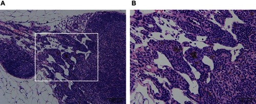 Figure 4 Histological image of the thin-MWCNTs (high-dose) group in which MWCNTs. (A) Black MWCNTs were deposited in part of the pancreas. (B) An enlarged image of (A) surrounded by a white frame. No occurrence of tumors were found surrounding the MWCNTs.Abbreviation: MWCNTs, multiwalled carbon nanotubes.
