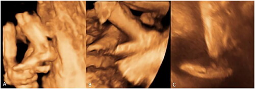 Figure 4. Comparison of the normal foot and foot of a fetus with CVT by three-dimensional ultrasound. (A) The image shows the normal foot of a fetus using three-dimensional ultrasound. (B, C) The images show “rocking chair” morphology in fetuses with CVT under three-dimensional ultrasound.