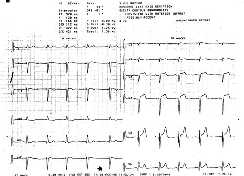 Figure 1 The EKG of our patient showed sinus rhythm of 62/min, an abnormal left axis deviation consistent with left anterior hemiblock, Q waves in the precordial leads, and prominent ST elevation in leads V3–V5.