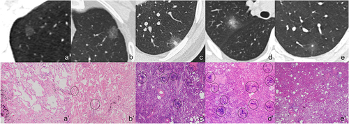 Figure 1 A 52-year-old man with an incidental GGN. (a) Axial CT image shows a 6-mm round and well-defined pGGN with smooth margin located in the right upper lobe. (a’) Histopathologic analysis reveals fibrous tissue hyperplasia without inflammatory cells. A 76-year-old man with an incidental GGN. (b) Axial CT image shows a 17-mm oval and well-defined pGGN with coarse margin located in the left upper lobe. (b’) Histopathologic analysis reveals fibrous tissue hyperplasia with less inflammatory cells (black circles). A 24-year-old man with an incidental GGN. (c) Axial CT image shows a 17-mm oval and well-defined PSN with coarse margin located in the left lower lobe. (c’) Histopathologic analysis reveals fibrous tissue hyperplasia with more inflammatory cells (black circles). A 46-year-old man with cough and expectoration and a smoking history of 20 years. (d) His father has lung cancer. Axial CT image shows an 18-mm irregular and ill-defined PSN with higher density (ΔCT=344HU) located in the right upper lobe. (d’) Histopathologic analysis reveals fibrous tissue hyperplasia with more inflammatory cells (black circles). A 49-year-old man with backache and a smoking history of 10 years. (e) Axial CT image shows a 14-mm oval and ill-defined PSN with lower density (ΔCT = 81HU) located in the left lower lobe. (e’) Histopathologic analysis reveals fibrous tissue hyperplasia without inflammatory cells.