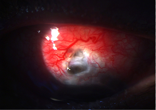 Figure 4 Scleral thinning 22-months post-trabeculectomy with mitomycin C.