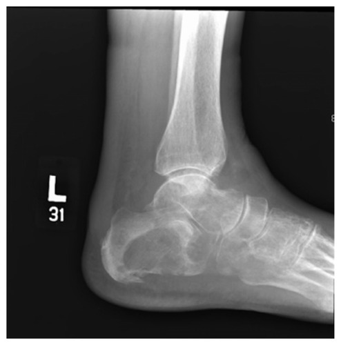 Figure 1 Radiograph of the left foot, demonstrating a large lytic lesion and destruction of the calcaneus, the cuboid, and the fifth metatarsal.