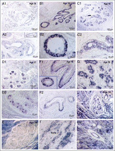 Figure 1 Photomicrographs of 4HNE immunostained breast tissue sections from nine subjects ranging in age from 14–19 illustrating some of the diversity of staining patterns. Sections were not counterstained. Images were captured via a Nikon Eclipse E600 microscope with Nomarski optics using Spot Digital Camera (Diagnostic Instruments, Inc.) and Image Pro Plus software (version 2). (A1 and A2) Sections from a 14-y-old girl with only a few weakly 4HNE immunopositive mammary epithelial cells at low power in A1 and high power in A2. Insert in lower panel shows a blood vessel with no immunostaining of the endothelium, i.e., no evidence of atherosclerosis. (B1 and B2) Two areas from a section from another 14-y-old girl with intense immunostaining throughout the mammary epithelium: Upper panel shows growing ducts and the lower panel shows at high power a cross section of a duct with 4HNE+ mammary epithelial cells localized mainly in the basal epithelium. (C1 and C2) Upper panel shows at low power a terminal lobular ductal unit (TDLU) from a 19-y-old subject in which mammary epithelial cells are relatively weakly 4HNE immunopositive. Lower panel, the area marked by an arrow in the upper panel, photographed at high power shows localization of immunostaining in luminal epithelial cells. (D1 and D2) Two areas in a tissue section from a 17-y-old girl in which there are only a few intensely 4HNE immunopositive cells. The random localization of these 4HNE+ cells and the granularity of the immunostaining suggest that these might be macrophages, a supposition that needs to be confirmed using a macrophage marker, such as CD68. (E) An essentially immunonegative TDLU surrounded by intensely immunopositive collagenous stroma in a tissue section from a 16-y-old girl. (F1 and F2) 4HNE+ mammary epithelial cells in two growing ducts in a section from a 19-y-old subject. The immunostaining is more intense and widespread in (F1) and less intense and restricted to the tip of the growing duct in (F2). Insert in (F1) shows localization of immunostaining in basal epithelial cells. (G) A portion of a TDLU in a section from an 18-y-old subject in which intense immunostaining is localized in the luminal epithelial cells. (H1 and H2) From a section from an 18-y-old subject in which intensely immunopositive stroma surrounds a TDLU in the upper panel and a blood vessel in the lower panel: the upper panel shows patchy immunostaining of luminal mammary epithelial cells while the lower panel shows immunostaining of the endothelium of the blood vessel indicating atherosclerosis. (I) A section of an aorta, used as a positive control, showing streaks of 4HNE immunostaining indicating atherosclerotic lesions. Control sections incubated with medium from which the primary 4HNE antibody was omitted were uniformly immunonegative.