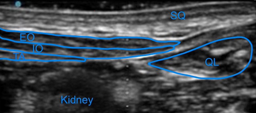 Figure 1 Quadratus Lumborum block anatomy visualized with high frequency linear probe prior to injection, showing respectively the subcutaneous tissue (SQ), external oblique (EO), internal oblique (IO), transversus abdominis (TA), quadratus lumborum (QL), and kidney.