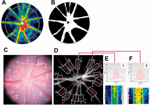 Figure 2. Representative images of rat fundus around the optic nerve head and measurements of retinal vessel diameters using LSFG-Micro. (A) Representative color-coded blood flow map produced by LSFG-Micro. The white circle shows a rubber band – the region of interest to measure MBR by LSFG in the optic nerve head. (B) Binary image for automated segmentation between the visible vessel area (white) and tissue area (black), using LSFG analysis software. (C) Representative fundus photographs of a normal rat used in this study. (D) Total retinal artery and vein analysis in the same rat retina as (C). The rectangular areas were set semiautomatically to the vessels. (E,F) show the vessel diameter index in rectangles 1 and 2, respectively. A: Artery; LSFG: laser speckle flowgraphy; MBR: mean blur rate; V: Vein.