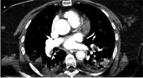 Figure 4. CTPE showing pulmonary artery embolism.