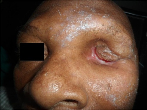 Figure 4 Spontaneous healing of the orbital cavity.