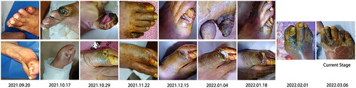 Figure 1. Progression of the cutaneous lesion (the metatarsal bone, the third toe, and the little toe suffered the most and presented with ulcers within one week, accompanied by pain and progressive cutaneous darkening and sclerosis. The skin temperature was low at the initial stage. In addition, the patient had weakened bilateral dorsalis pedis pulses, especially on the right side).