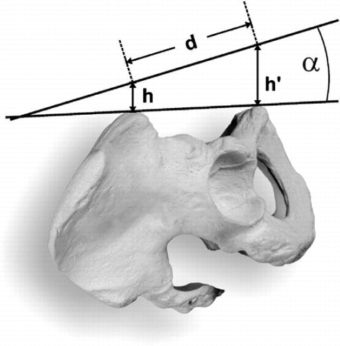 Figure 3. Calculation of the correction angle. H is the depth of tissue over the ASIS, h' is the depth of tissue over the symphysic tubercles, and d is the distance between the symphysis and a line between the two ASIS.