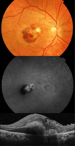 Figure 2 Recurrence of the choroidal neovascularization activity with a central macular thickness of 349 μm.