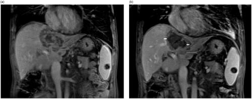 Figure 2. An example of partial response for HIFU ablation. The patient is a 54-year-old male with liver metastasis from rectal cancer. The contrast-enhanced MRI showed that pre-procedure hepatic lesions at segment VIII and segment I invaded the vena cava and hepatic vein (a) and the non-perfused area occupied more than 70% of the whole tumor (white arrow) after HIFU ablation (b).