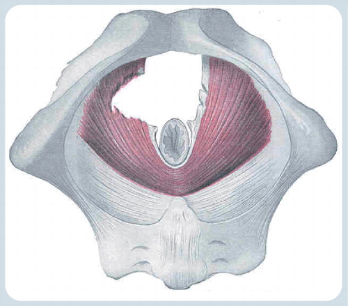 Figure 1. Right-sided avulsion seen from the caudal view.This illustration is not entirely correct, as in most cases there appears to be very little or no muscle left on the bone since the tear occurs at the insertion rather than in the muscle belly. However, the figure correctly describes the most common form of trauma, affecting the right puborectalis muscle, with retraction of muscle fibers perianally, and its most common cause at the time (i.e., forceps delivery).Reproduced with permission from Citation[2].
