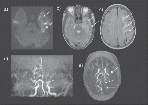 Figure 2. An SCD patient presented with seizures and a right sided neurological deficit (B) Axial T2-weighted images shows an acute left temporal lobe infarct in the left middle cerebral artery (MCA) territory with (A) restricted diffusion on the apparent diffusion map (ADC) map (arrows). (C) The FLAIR sequence revealed extensive mature ischemic changes within the subcortical, deep and periventricular white matter of the centrum semiovale, more marked on the left (arrows). (D) MRA revealed bilateral occluded terminal internal carotid arteries (ICA) and multiple moyamoya and pial collaterals (arrows). (E) The left posterior cerebral artery (PCA) is narrowed with distal pial vessels visible (arrows). FLAIR = fluid attenuated inversion recovery
