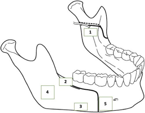 Figure 1. Ramus sagittal osteotomy according to Epker's technique: full lines and tear lines correspond to the osteotomy course and to the directed fracture along the alveolar inferior nerve canal respectively.