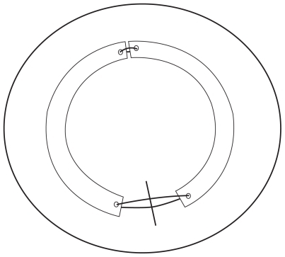 Figure 1 Schematic of the Intacs segments coupled with suture at both ends. The radial corneal incision is depicted inferiorly prior to suture closure.