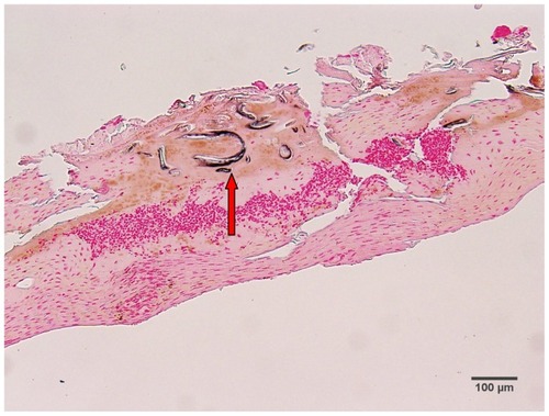 Figure 3 Fontana-Masson-stained section from patient 3, demonstrating positive melanin staining of blue filament sections (arrow). 100× magnification.