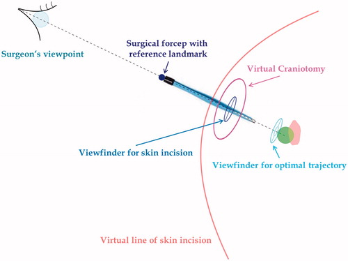 Figure 8. Schematic drawing of the AR visualization modality chosen by the surgeons. The AR visualization modality selected by the surgeons for aiding the targeting of the lesion was obtained by merging the traditional anatomy-based visualization modality that resulted the most effective in evoking depth perception (i.e. Anatomical Occlusions and transparencies) with the one allowing a more accurate definition of the ideal trajectory for targeting the hidden lesion (i.e. Occluding virtual viewfinders).