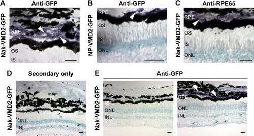 Figure 3 GFP is expressed in the RPE after delivery of VMD2-GFP-S/MAR.Notes: (A–E) Immunohistochemistry was performed on retinal sections with antibodies against GFP (A, B, E), RPE65 as a control for RPE labeling (C), or with secondary antibodies alone (D). The purple coloring indicates GFP/RPE65 antibody labeling with nuclei counterstained with methyl green (teal). White arrowheads indicate expression in the RPE. (E) Images at 20× from a region not expressing GFP (left) and a region expressing GFP (right). Animal/eye numbers are as follows: (A, C, D, E) 7R, (B) 7L. Scale bar: 25 µm.Abbreviations: INL, inner nuclear layer; IS, inner segment; Nak, naked plasmid; NP, nanoparticle; ONL, outer nuclear layer; OS, outer segment; RPE, retinal pigment epithelium; Sal, saline; UN, uninjected.